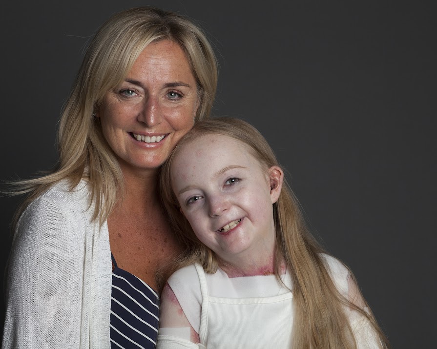 Irish teen Claudia to compete in marathon to help raise funds for others with rare skin condition