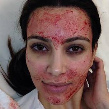 I tried PRP therapy, the Vampire Facial for your eyes