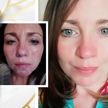 ‘This face scrub was the only product that reduced my acne’ – and it’s Irish-made