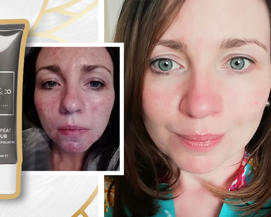 ‘This face scrub was the only product that reduced my acne’ – and it’s Irish-made