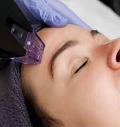 Why everyone’s talking about the skin-tech breakthrough Morpheus8 Burst