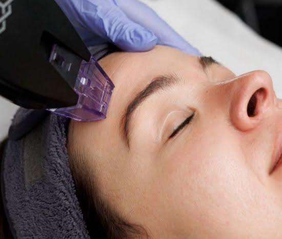 Why everyone’s talking about the skin-tech breakthrough Morpheus8 Burst