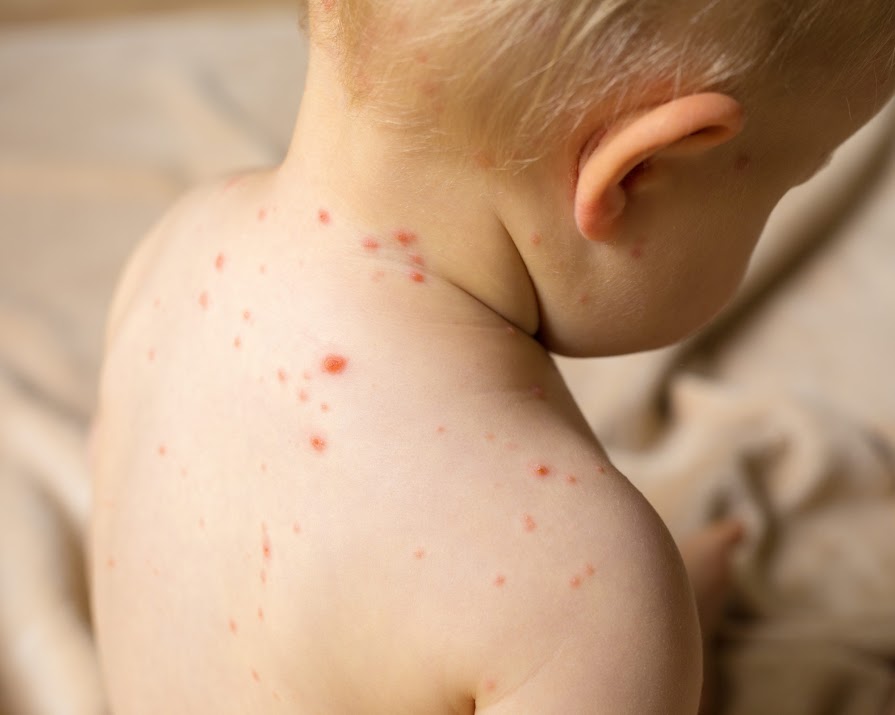 Measles outbreak confirmed in North Dublin