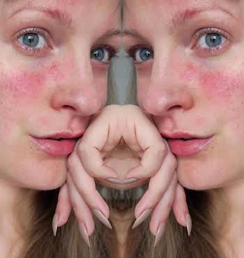 rosacea