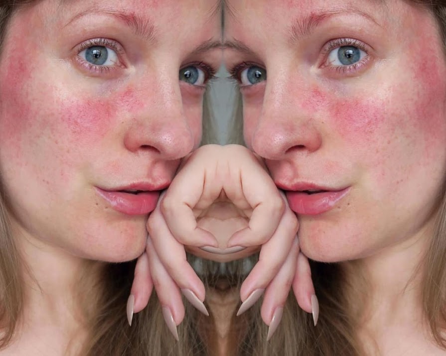 A dermatologist’s guide to rosacea